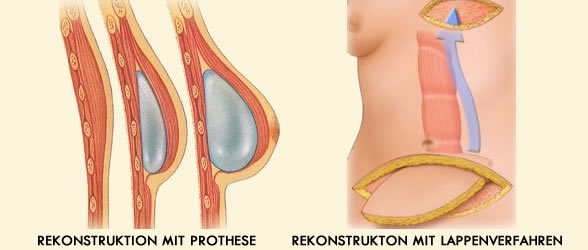 Brustrekontsruktion
