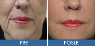 Lipofiling lica