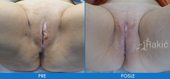 lihen skleroza vagine.jpg