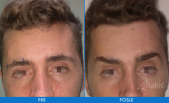Podizanje obrva 