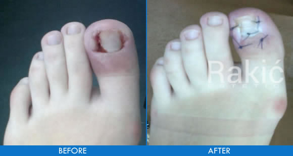 Ingrown toenail