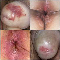lihen sclerosis anogenitalne regije.jpg