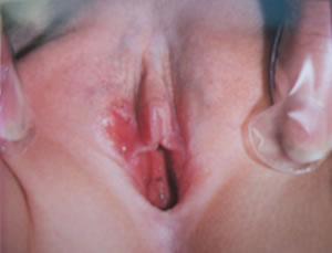 vaginalna atrofija.jpg